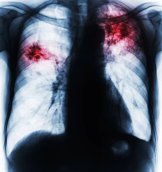 肺结核。胸部 x 光胶片显示纤维化，间质浸润由于结核杆菌感染两肺 . — 图库照片