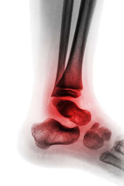 Artrite de tornozelo (reumatoide juvenil ) — Fotografia de Stock