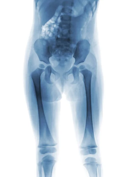 Film x-ray body of child ( Lower half of body ) — Stock Photo, Image