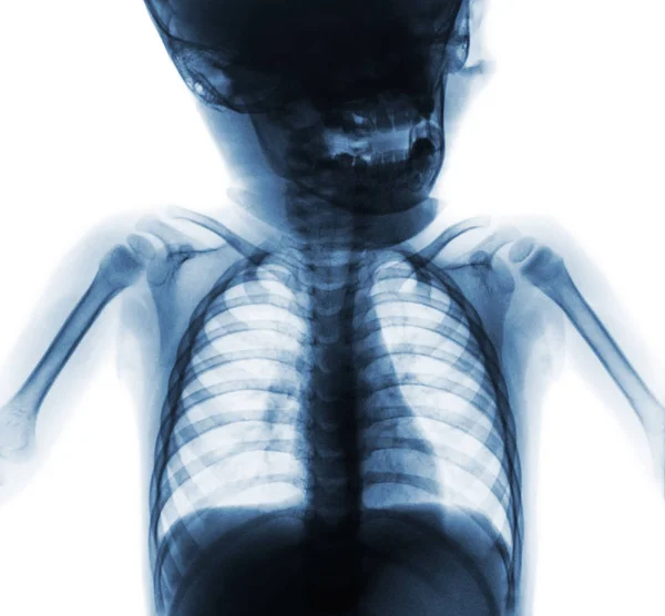 Film radiographie poitrine normale du bébé. La moitié supérieure du corps. Vue de face — Photo