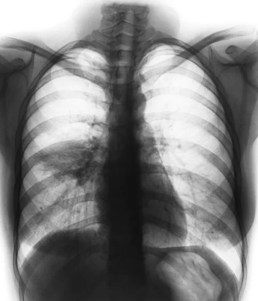 Пневмонія (плівкове рентгенівське випромінювання грудної клітини показує альвеолярне проникнення в праву середню легеню  ) — стокове фото