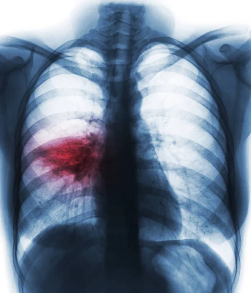 （电影胸部 x 光显示肺泡浸润在右中叶肺肺炎 ) — 图库照片