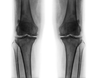 Her iki diz osteoartrit .