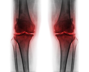 Her iki diz osteoartrit .