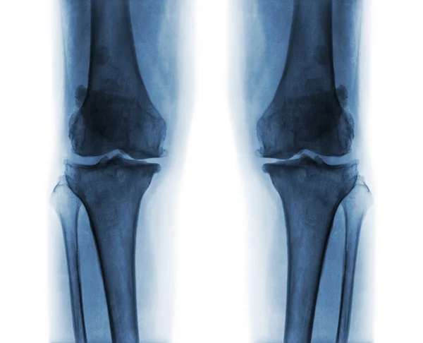Choroba zwyrodnieniowa stawów, które oba kolana . — Zdjęcie stockowe