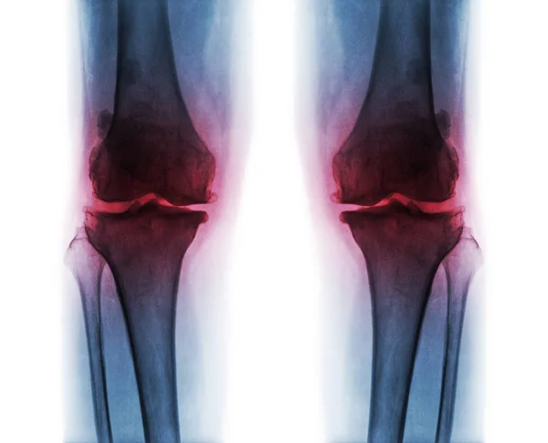 Osteoartrite ambos os joelhos  . — Fotografia de Stock