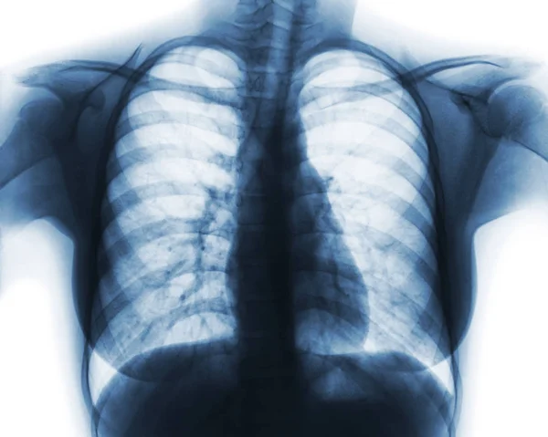 Film chest x-ray of normal woman chest — Stock Photo, Image