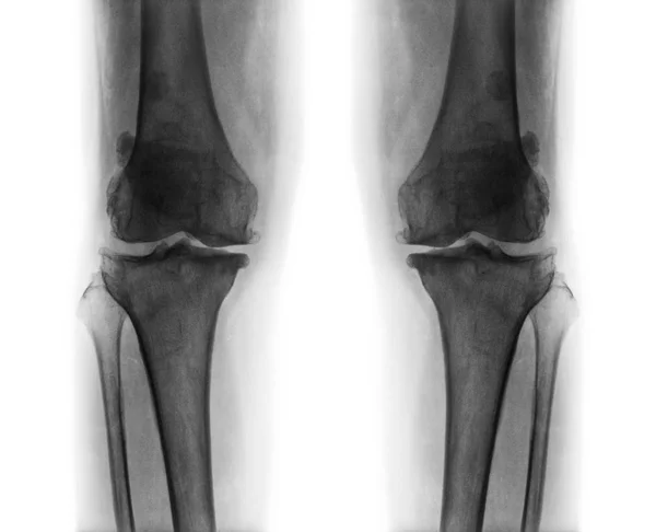 Osteoartrite ambos os joelhos  . — Fotografia de Stock
