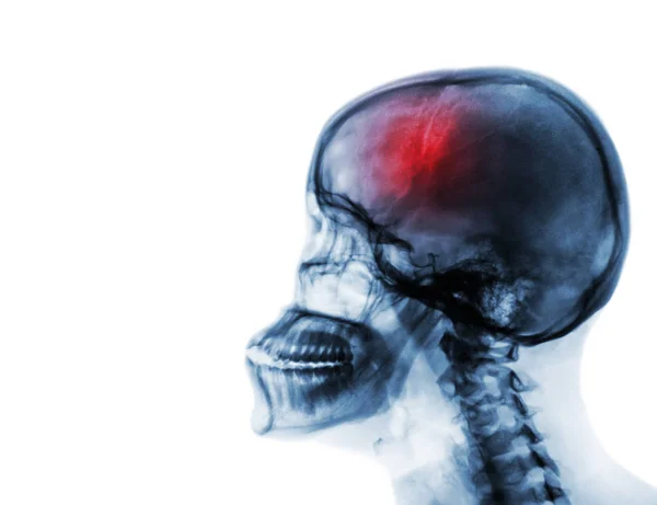 Un AVC. Accident vasculaire cérébral. Film radiographie du crâne humain et de la colonne cervicale  . — Photo