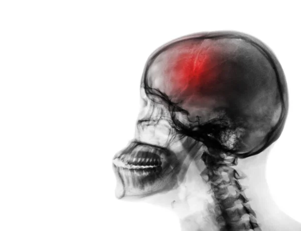 Traço. Acidente vascular cerebral. Radiografia por película de crânio humano e coluna cervical  . — Fotografia de Stock