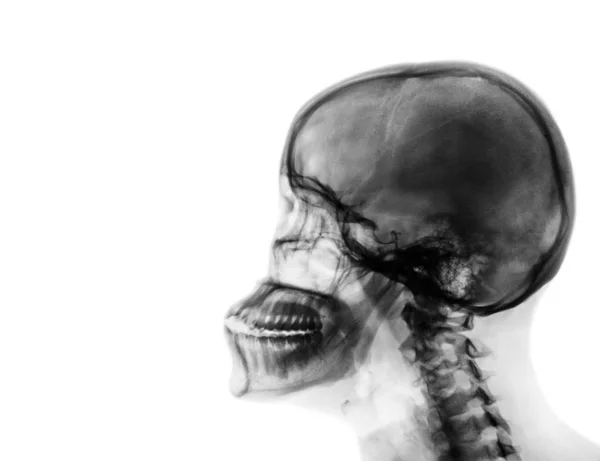 Rayos X cráneo normal y columna cervical. Vista lateral  . — Foto de Stock