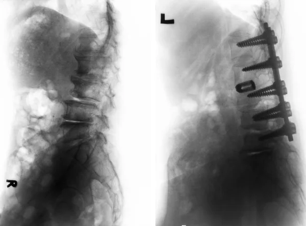 Spondylosis . Before and After surgery . — Stock Photo, Image