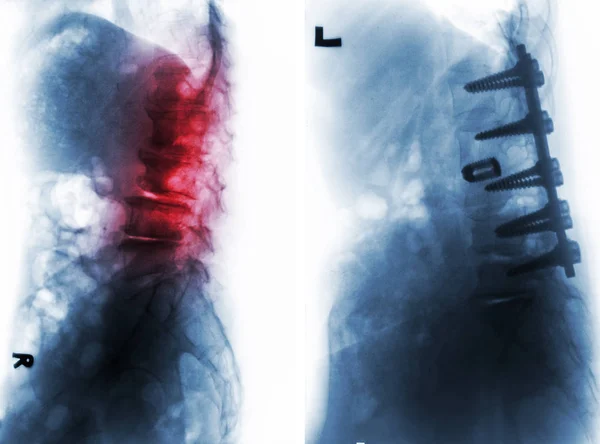 Spondylosis. Sebelum dan Setelah operasi  . — Stok Foto