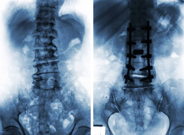 Spondylosis. Műtét előtt és után . — Stock Fotó