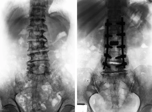 Spondylosis . Before and After surgery . — Stock Photo, Image