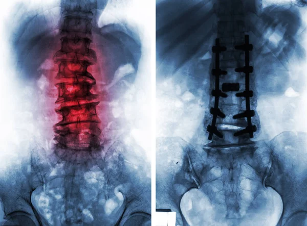 Espondilose. Antes e depois da cirurgia  . — Fotografia de Stock