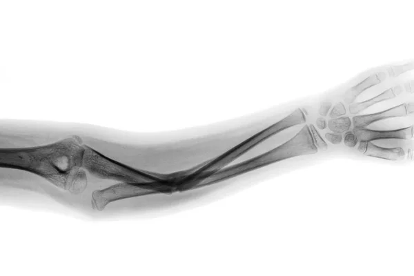 Película de rayos X antebrazo AP muestran fractura eje de hueso cubital —  Fotos de Stock