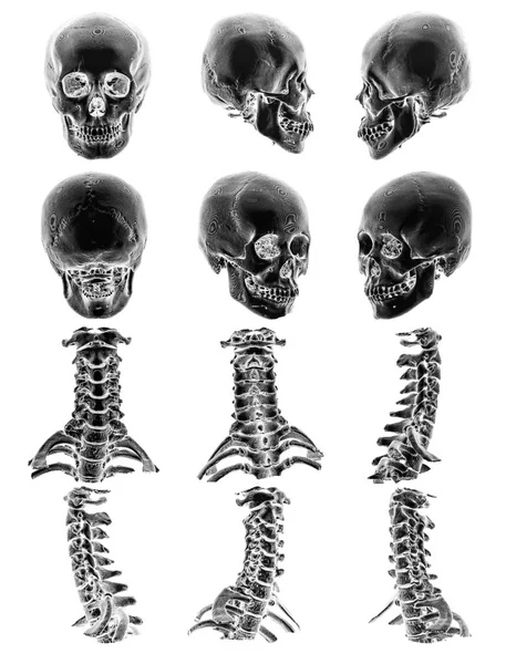 La tomografía computarizada (TC) con gráfico 3D muestra el cráneo humano normal y la columna cervical —  Fotos de Stock