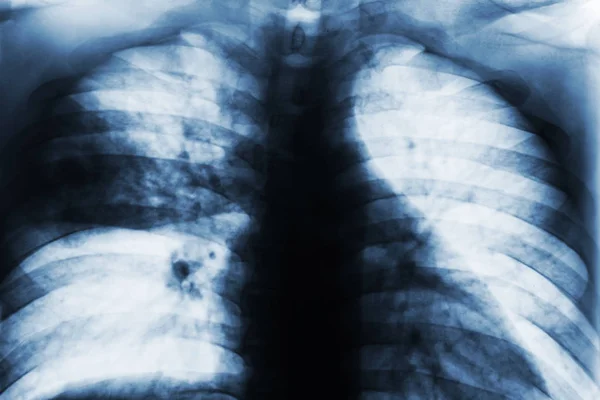 Λοβού πνευμονία. Ακτινογραφία θώρακος ταινία δείχνουν αποσπασματική διεισδύσει στο μεσαίο δεξί πνεύμονα από Mycobacterium φυματίωση μόλυνση (πνευμονική φυματίωση ) . — Φωτογραφία Αρχείου