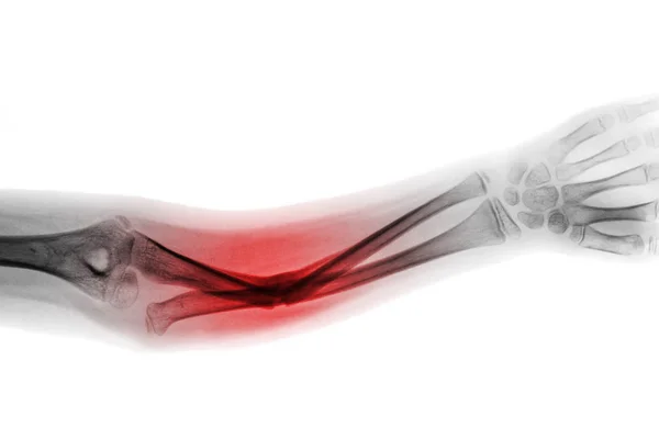 Film x-ray forearm AP show fracture shaft of ulnar bone — Stock Photo, Image
