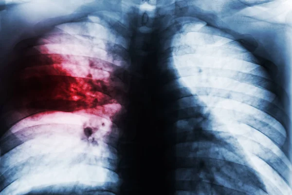 Lobar Pneumonia . Film chest x-ray show patchy infiltrate at right middle lung from Mycobacterium tuberculosis infection ( Pulmonary tuberculosis ) . — Stock Photo, Image