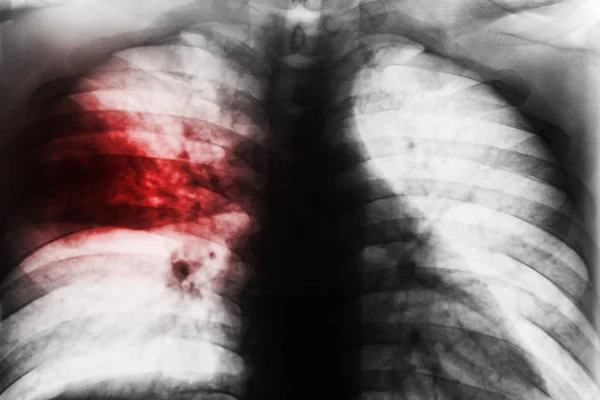 Lobar Pneumonia . Film chest x-ray show patchy infiltrate at right middle lung from Mycobacterium tuberculosis infection ( Pulmonary tuberculosis ) . — Stock Photo, Image