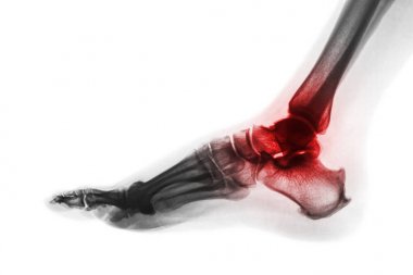 Arthritis of ankle . X-ray of foot . Lateral view . Invert color style . Gout or Rheumatoid concept clipart