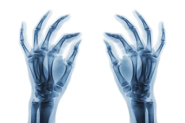 Рентген нормальных человеческих рук на белом фоне. Наклонный вид — стоковое фото