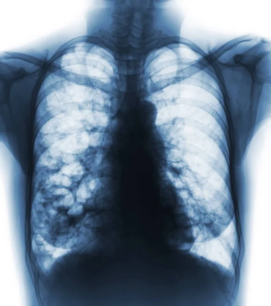 Rozstrzenie oskrzeli. RTG klatki piersiowej Pokaż wielu pęcherzyków płuc i torbiel z powodu przewlekłego zakażenia. Widok z przodu — Zdjęcie stockowe
