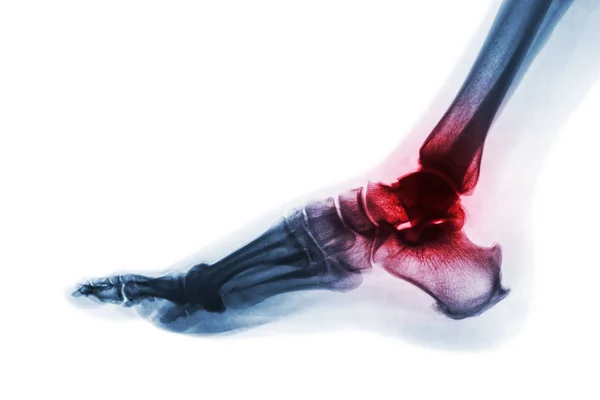 Arthritis of ankle . X-ray of foot . Lateral view . Invert color style . Gout or Rheumatoid concept — Stock Photo, Image