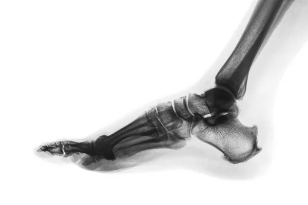 X-ray normalnej ludzkiej stopy. Widok boczny. Odwracanie kolorów stylu — Zdjęcie stockowe