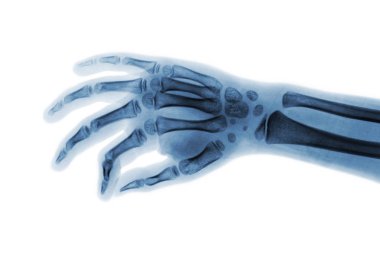 Film x-ışını el çocuğun. Eğik görünümü