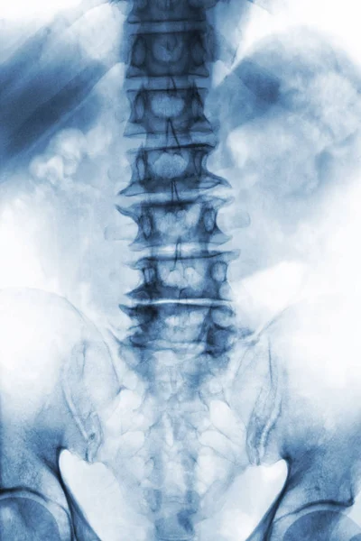Espondilosis. radiografía de la columna lumbosacra de la película del paciente anciano muestra osteófita, colapso de la columna vertebral del proceso degenerativo. Vista frontal —  Fotos de Stock