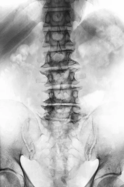 Spondylóza. Film RTG lumbosakrální páteře starých věku pacientů Ukázat osteofytů, kolapsu páteře z degenerativního procesu. Pohled zepředu — Stock fotografie