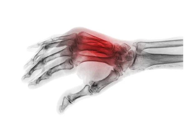 Fraktur på 3rd och 4th mellanhandsbenet ben. Film röntgen av vuxna händer. Sneda Visa — Stockfoto