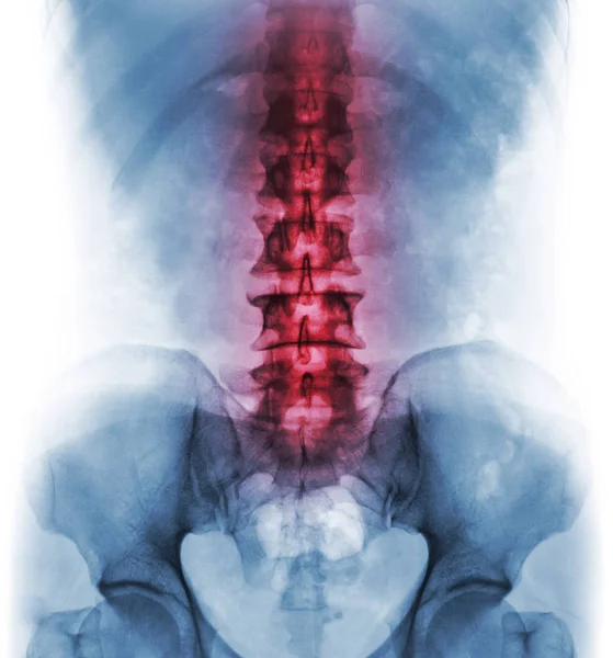 Inflamación de la columna lumbosacra. Concepto de cuidado vertebral — Foto de Stock