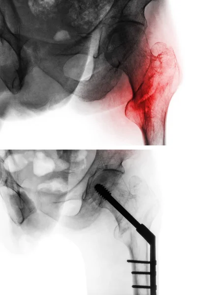 Intertrochanteric fracture femur ( thigh bone ). X-ray of hip and comparison between before surgery (upper image) and after surgery (lower image). Patient was operated and insert intramedullary nail