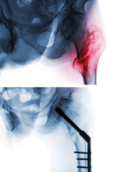 Intertrochanteric fractuur femur (dijbeen bot). Röntgenfoto van heup- en vergelijking tussen voor operatie (bovenste afbeelding) en na de operatie (onderste afbeelding). Patiënt werd geëxploiteerd en invoegen van intramedullaire nagel — Stockfoto