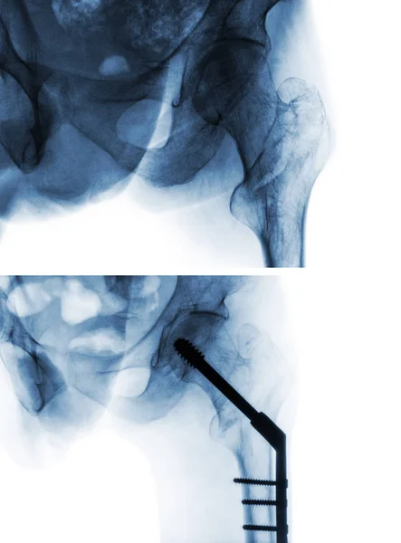 Інтертромеханічний перелом стегнової кістки (кістки стегна). Рентген стегна та порівняння між хірургічним втручанням (верхнім зображенням) та після операції (нижнім зображенням). Пацієнт оперував і вставляв інтрамедулярний цвях — стокове фото