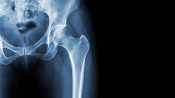 X-ray normal pelvis and hip joint . Blank area at right side — Stock Photo, Image