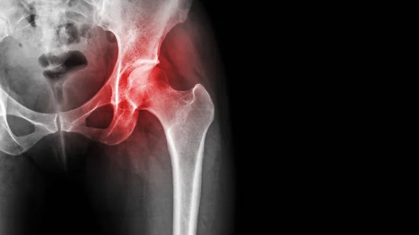 Arthritis am Hüftgelenk. Film-Röntgenaufnahme zeigt eine Entzündung des Hüftgelenks und der weißen Stelle an der rechten Seite. Konzept der avaskulären Nekrose — Stockfoto