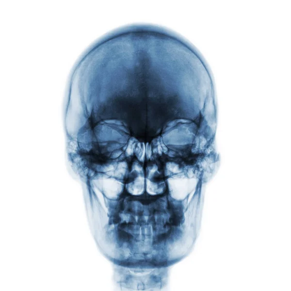 Рентген нормального человеческого черепа на изолированном фоне. Вид спереди — стоковое фото