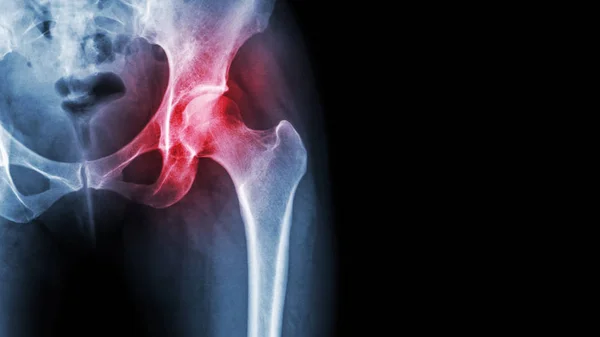 在髋关节关节炎。X 光胶片显示发炎的髋关节和右侧的空白区域。股骨头缺血性坏死的概念 — 图库照片