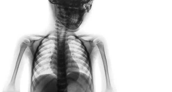 Filme de raio-X metade superior do corpo da criança e área em branco no lado direito — Fotografia de Stock