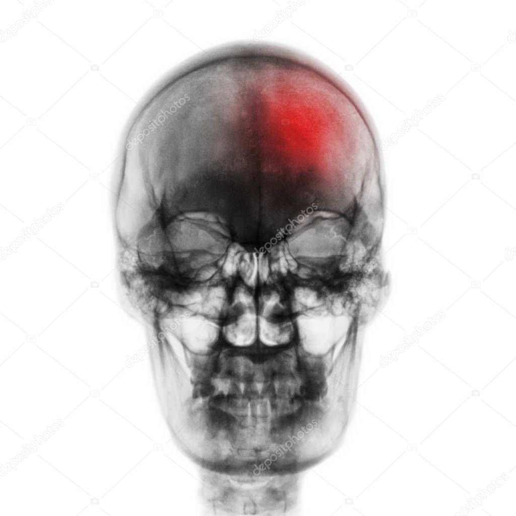 Stroke ( Cerebrovascular accident ) . Film x-ray skull of human with red area . Front view