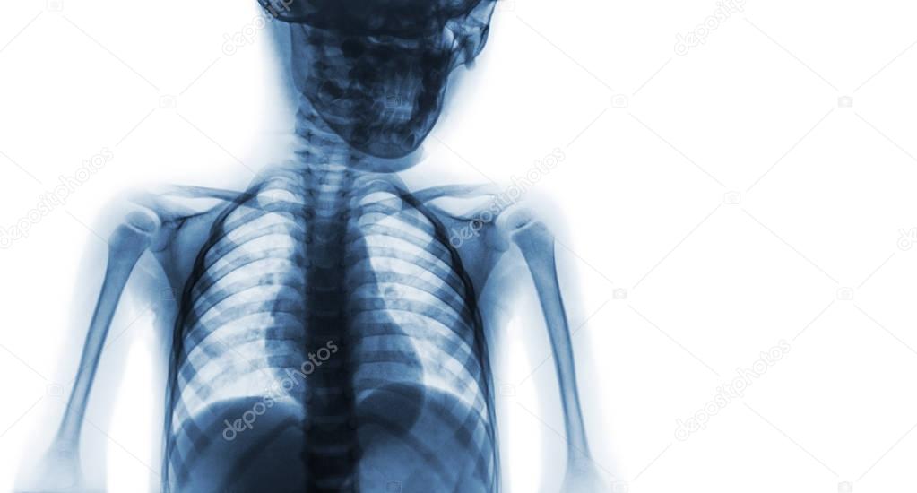 Film x-ray upper half body of child and blank area at right side