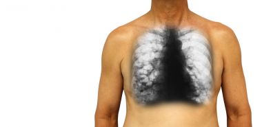 Bronchiectasis .  Human chest with x-ray chest show multiple lung bleb and cyst due to chronic infection . Isolated background . Blank area at Left side clipart