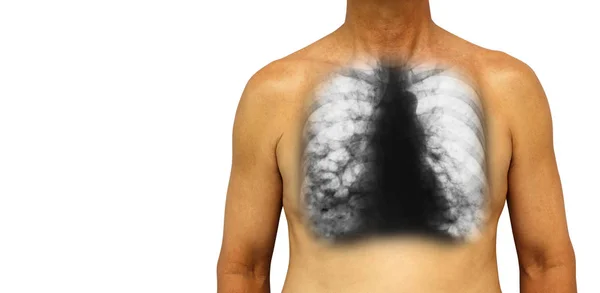 Bronchiëctasieën. Menselijke borst met x-ray borst tonen meerdere Long bleb en cyste als gevolg van chronische infectie. Geïsoleerde achtergrond. Leeg gebied op de linker kant — Stockfoto