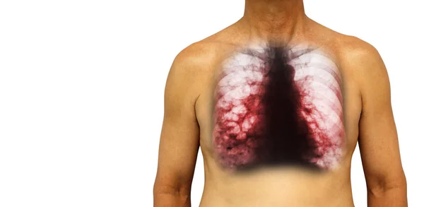 Bronquiectasias. O tórax humano com radiografia de tórax mostra múltiplas bolhas pulmonares e cistos devido a infecção crônica. Fundo isolado. Área em branco no lado esquerdo — Fotografia de Stock