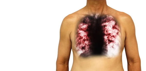 Pulmonary tuberculosis . Human chest with x-ray show cavity at right lung and interstitial infiltrate both lung due to infection . Isolated background . Blank area at Left side — Stock Photo, Image